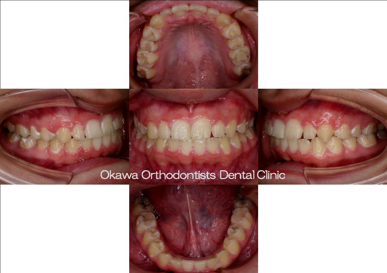 奥歯の咬合平面と下顎の位置の関係について【album 303】 | 石井歯科矯正歯科医院