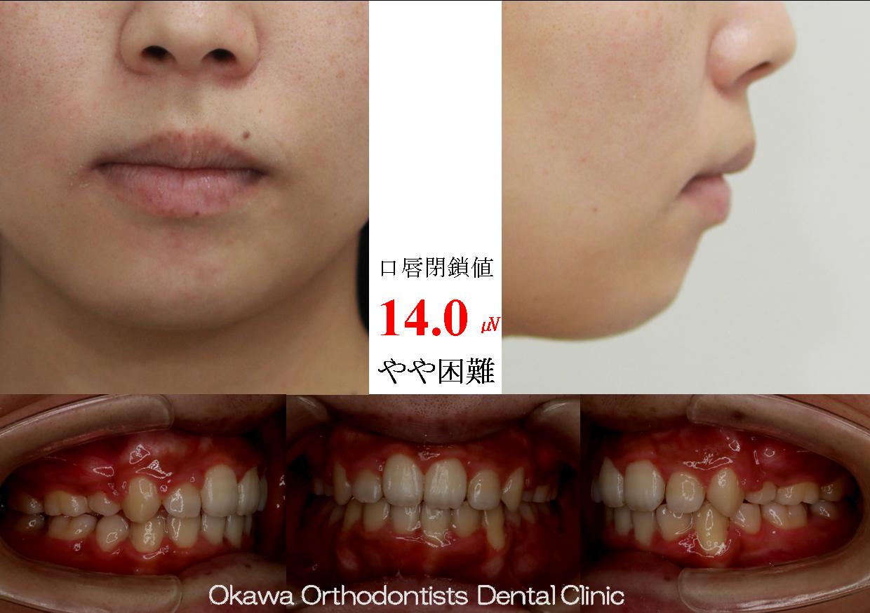 413. 上顎側切歯の口蓋側転位、クロスバイト｜大川矯正歯科クリニック 
